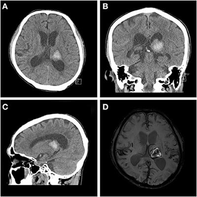 Case report: Improved behavioral and psychiatric symptoms with repetitive transcranial magnetic stimulation at the bilateral DLPFC combined with cognitive and behavioral therapy in a patient with unilateral thalamic hemorrhage